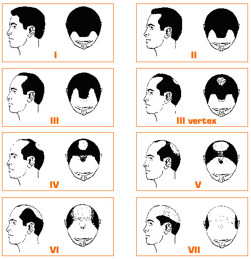 Chirurgia e cura della Calvizie
